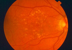 Picture Of A Retina After Eye Surgery In Brooklyn, NY - Brighton Eye Associates