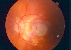 Image Of A Damaged Retina Shown During An Eye Exam In Brooklyn, NY - Brighton Eye Associates