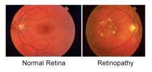 Image Of Retina Ready For Eye Laser Treatment In Brooklyn, NY - Brighton Eye Associates